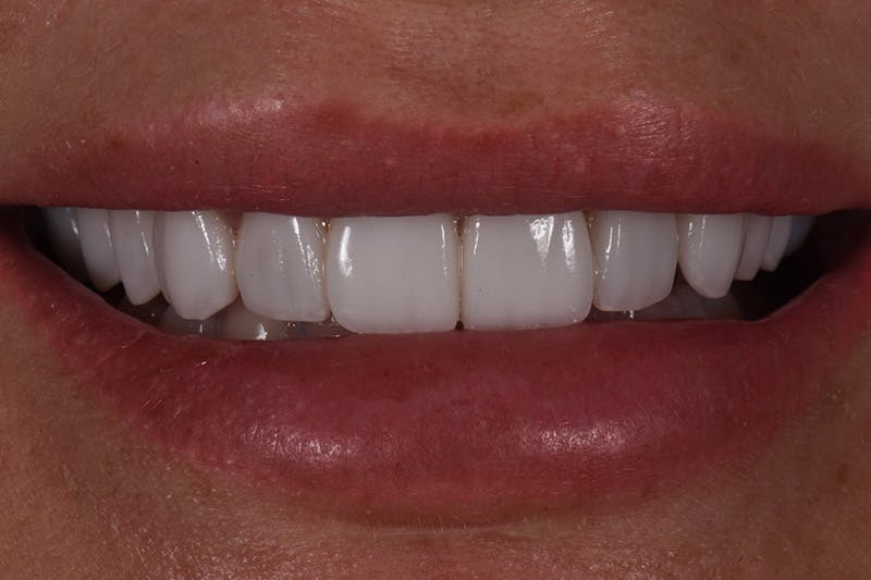 Patient Smile Before & After Gallery - Patient 303459 - Image 4