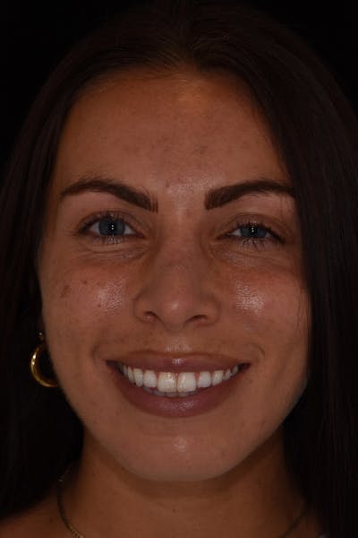 Patient Smile Before & After Gallery - Patient 218624 - Image 1