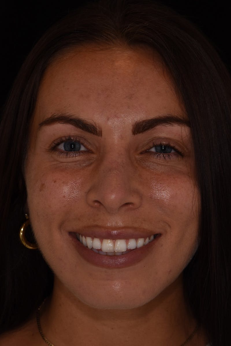 Patient Smile Before & After Gallery - Patient 218624 - Image 1