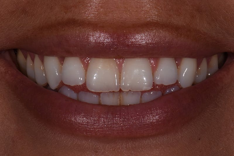 Patient Smile Before & After Gallery - Patient 218624 - Image 3