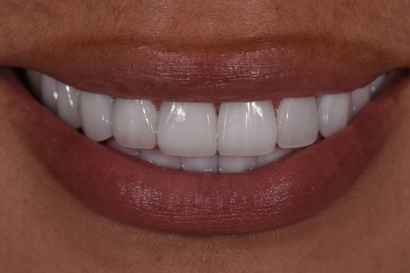 Patient Smile Before & After Gallery - Patient 218624 - Image 4