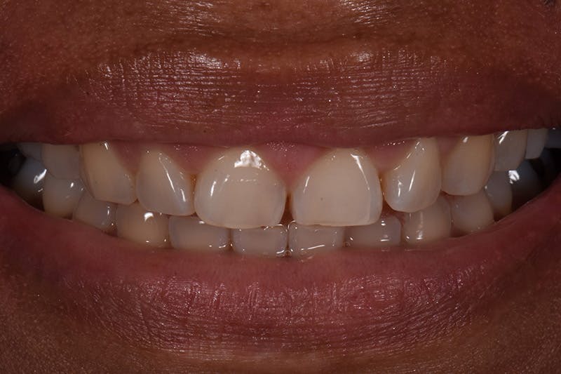 Patient Smile Before & After Gallery - Patient 228503 - Image 3