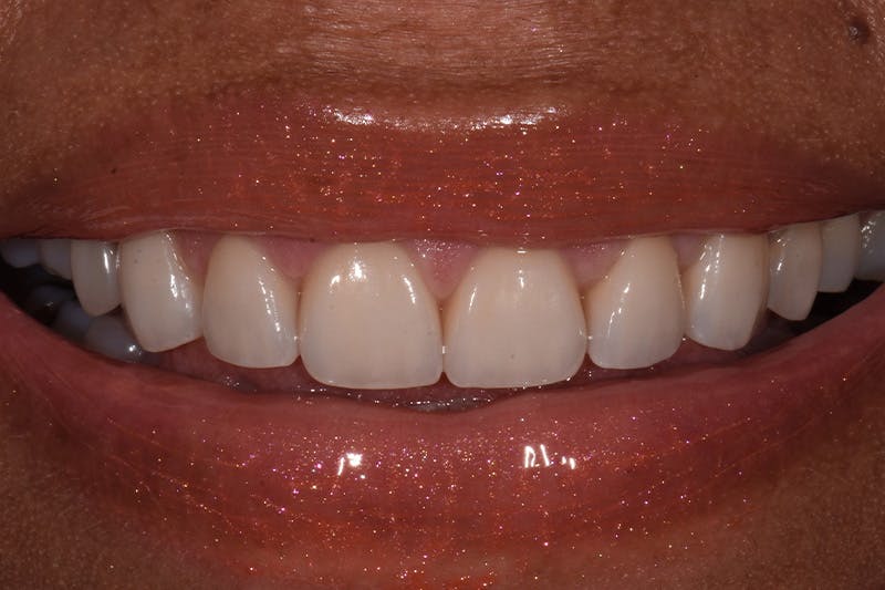 Patient Smile Before & After Gallery - Patient 228503 - Image 4