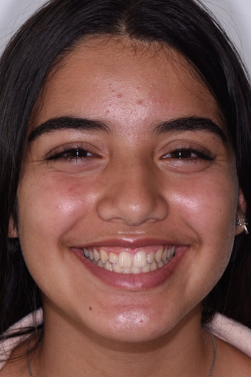 Patient Smile Before & After Gallery - Patient 252315 - Image 1