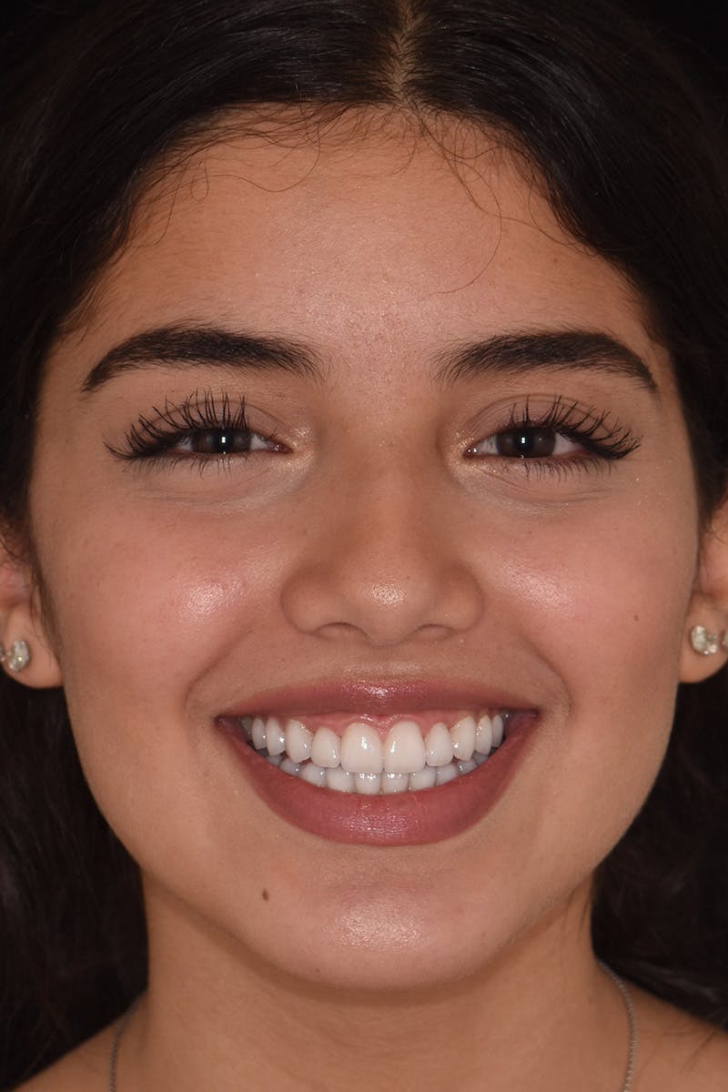 Patient Smile Before & After Gallery - Patient 252315 - Image 2
