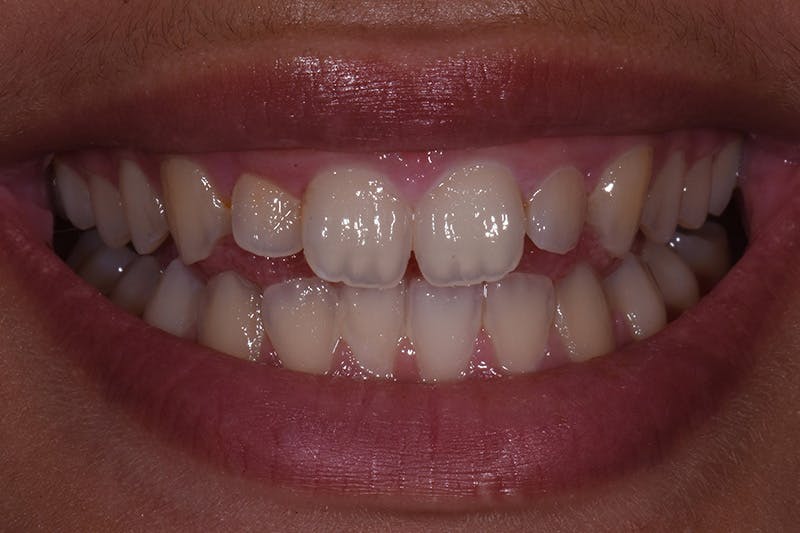 Patient Smile Before & After Gallery - Patient 252315 - Image 3