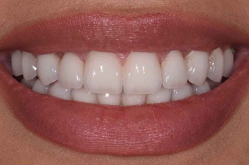 Patient Smile Before & After Gallery - Patient 252315 - Image 4
