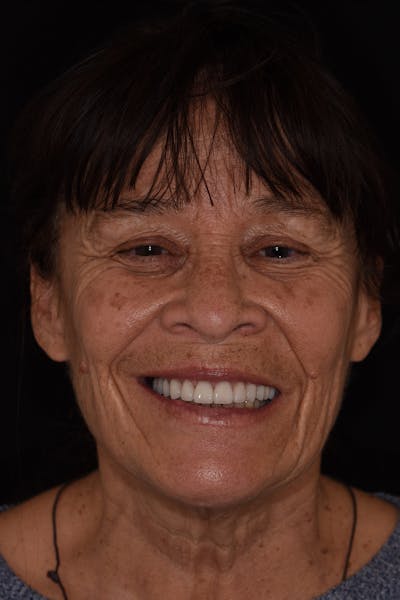 Patient Smile Before & After Gallery - Patient 128921 - Image 2