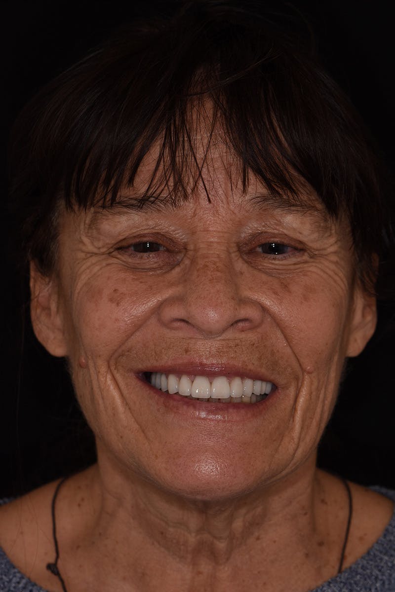 Patient Smile Before & After Gallery - Patient 128921 - Image 2