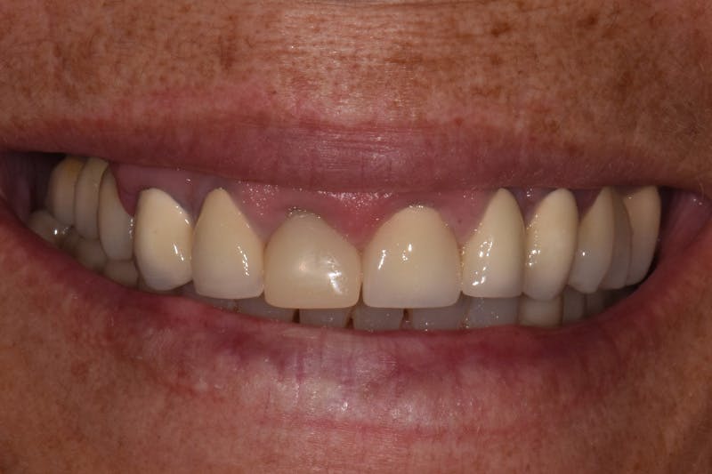Patient Smile Before & After Gallery - Patient 128921 - Image 3