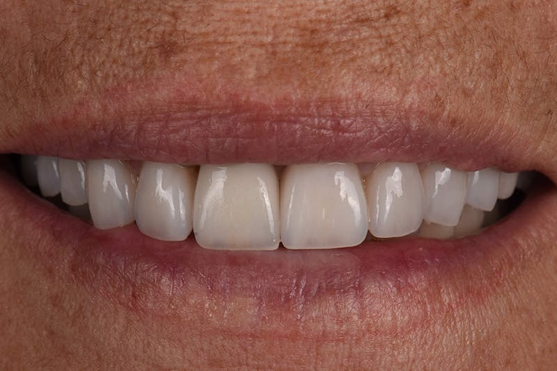 Patient Smile Before & After Gallery - Patient 128921 - Image 4