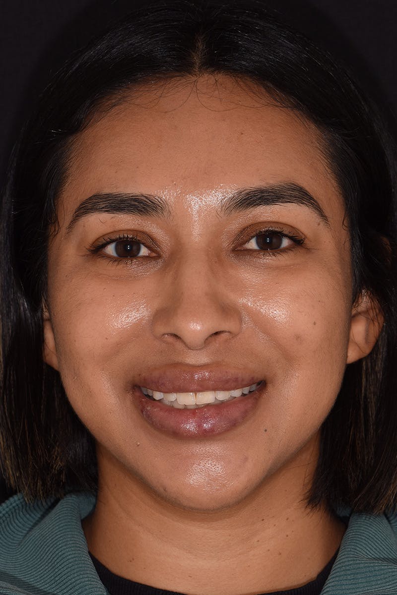 Patient Smile Before & After Gallery - Patient 144897 - Image 1