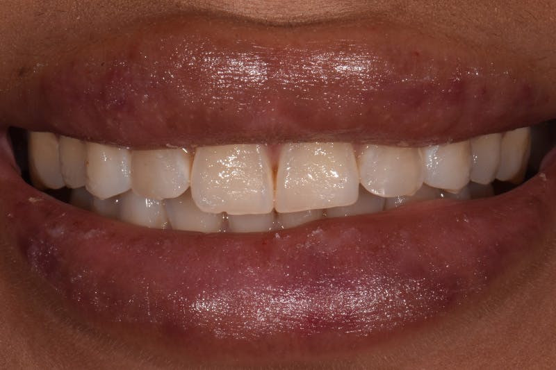 Patient Smile Before & After Gallery - Patient 144897 - Image 3