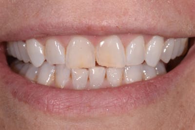 Patient Smile Before & After Gallery - Patient 225105 - Image 1