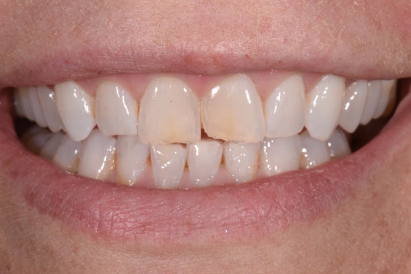 Patient Smile Before & After Gallery - Patient 225105 - Image 1