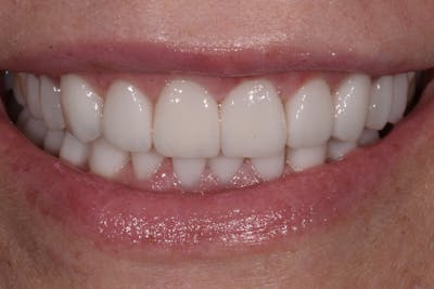 Patient Smile Before & After Gallery - Patient 225105 - Image 2