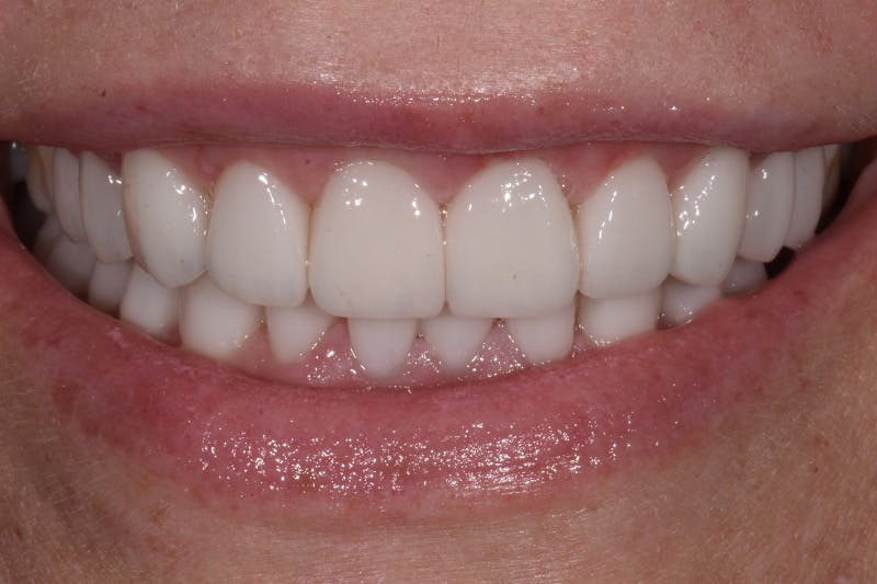 Patient Smile Before & After Gallery - Patient 225105 - Image 2
