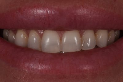 Patient Smile Before & After Gallery - Patient 277550 - Image 1