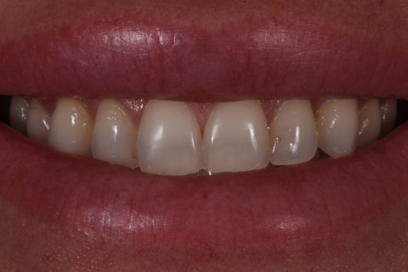 Patient Smile Before & After Gallery - Patient 277550 - Image 1