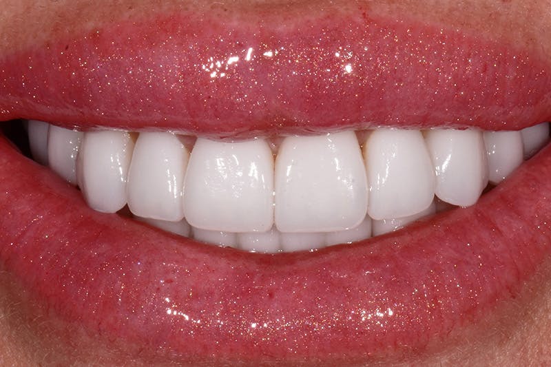 Patient Smile Before & After Gallery - Patient 277550 - Image 2