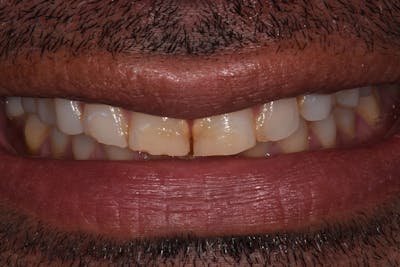 Patient Smile Before & After Gallery - Patient 216295 - Image 1