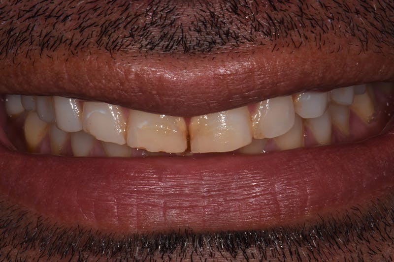 Patient Smile Before & After Gallery - Patient 216295 - Image 1