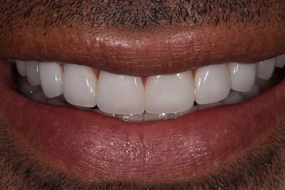 Patient Smile Before & After Gallery - Patient 216295 - Image 2