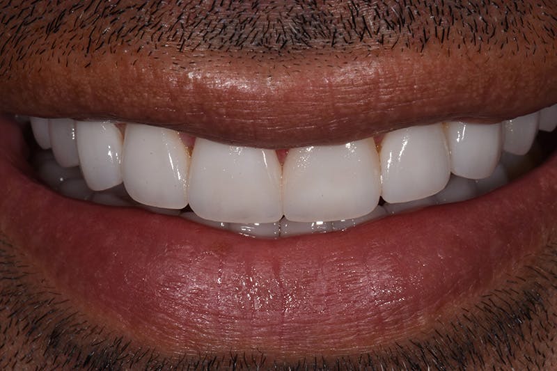 Patient Smile Before & After Gallery - Patient 216295 - Image 2