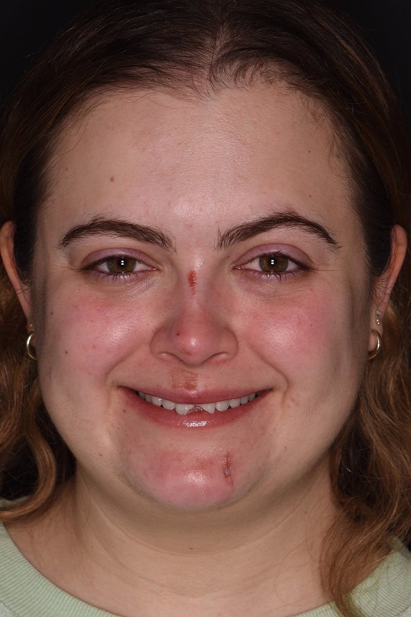 Patient Smile Before & After Gallery - Patient 233975 - Image 1