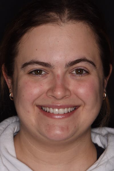 Patient Smile Before & After Gallery - Patient 233975 - Image 2