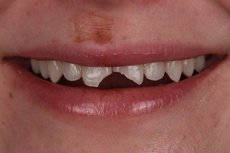 Patient Smile Before & After Gallery - Patient 233975 - Image 3