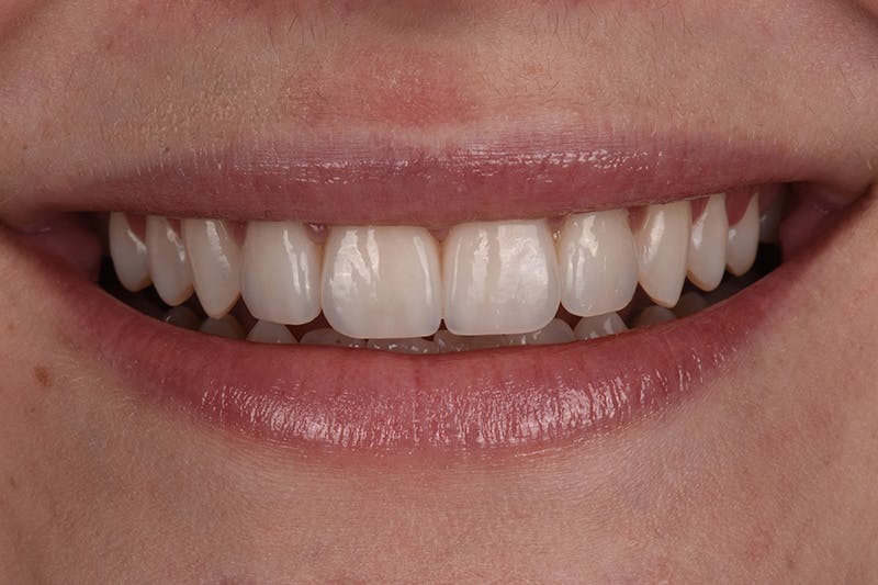 Patient Smile Before & After Gallery - Patient 233975 - Image 4