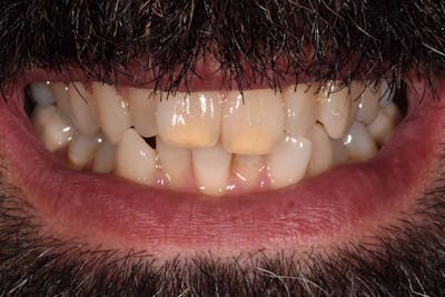 Patient Smile Before & After Gallery - Patient 291864 - Image 1