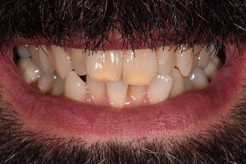 Patient Smile Before & After Gallery - Patient 291864 - Image 1