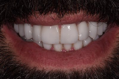 Patient Smile Before & After Gallery - Patient 291864 - Image 2