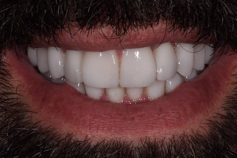 Patient Smile Before & After Gallery - Patient 291864 - Image 2