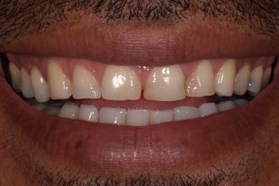 Patient Smile Before & After Gallery - Patient 103414 - Image 1