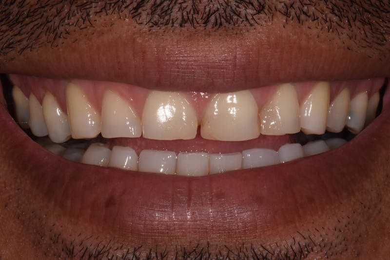 Patient Smile Before & After Gallery - Patient 103414 - Image 1