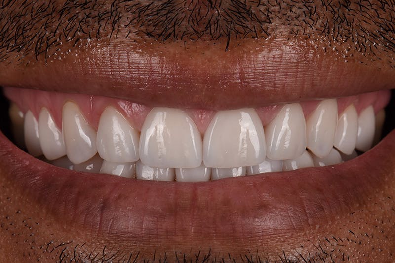 Patient Smile Before & After Gallery - Patient 103414 - Image 2
