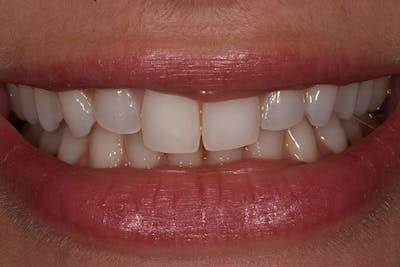 Patient Smile Before & After Gallery - Patient 306959 - Image 1