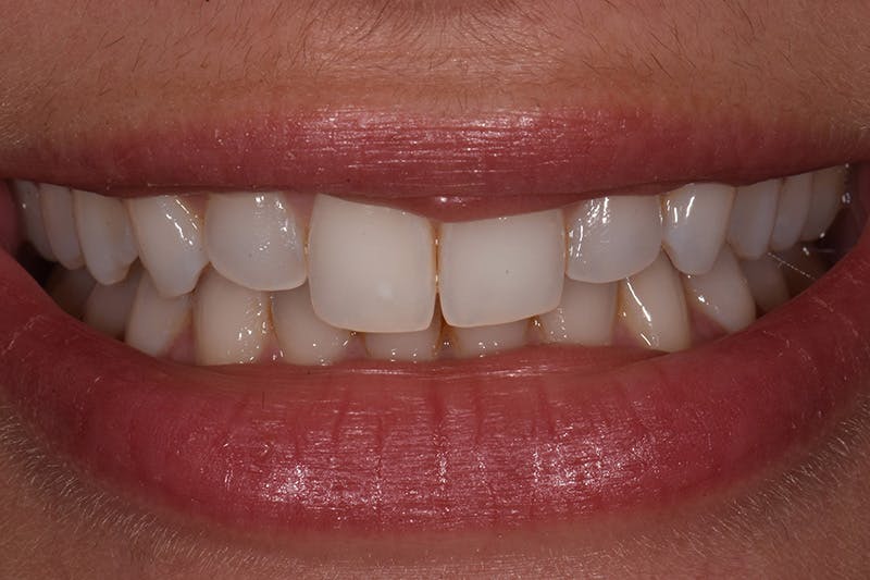 Patient Smile Before & After Gallery - Patient 306959 - Image 1