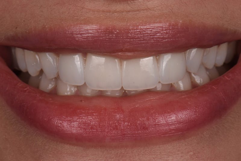 Patient Smile Before & After Gallery - Patient 306959 - Image 2