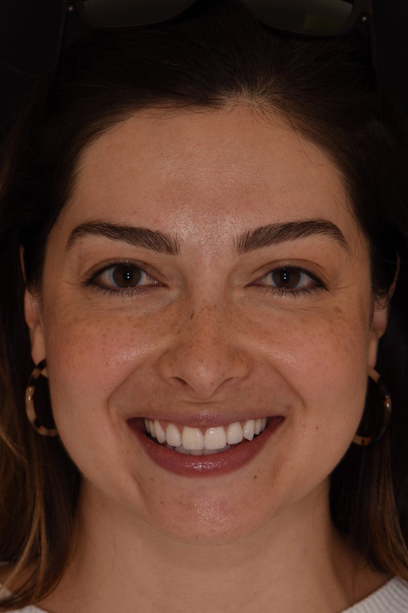 Patient Smile Before & After Gallery - Patient 227308 - Image 2