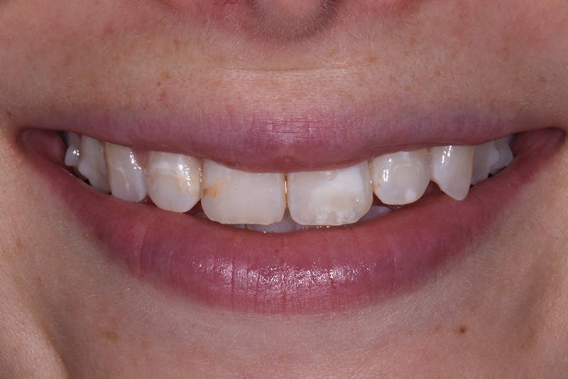 Patient Smile Before & After Gallery - Patient 227308 - Image 3