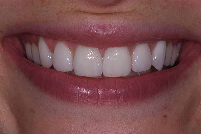 Patient Smile Before & After Gallery - Patient 227308 - Image 4