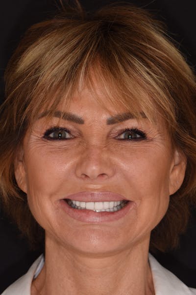 Patient Smile Before & After Gallery - Patient 871301 - Image 1