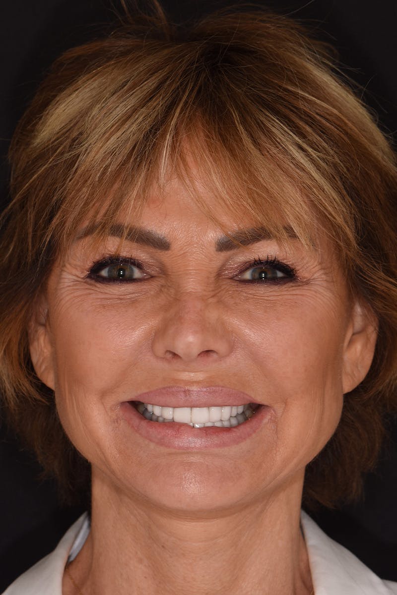 Patient Smile Before & After Gallery - Patient 871301 - Image 1