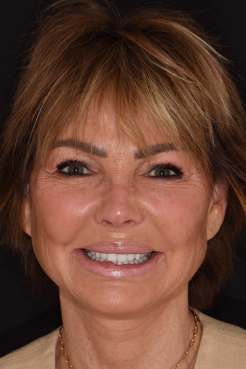 Patient Smile Before & After Gallery - Patient 871301 - Image 2