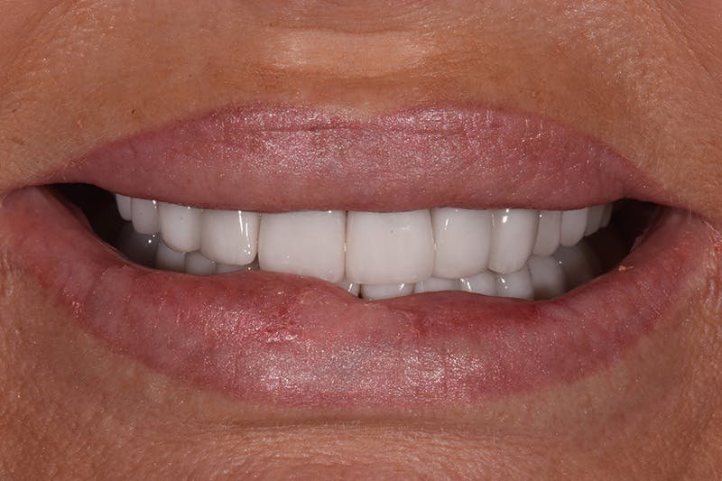 Patient Smile Before & After Gallery - Patient 871301 - Image 3
