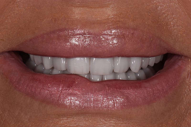 Patient Smile Before & After Gallery - Patient 871301 - Image 4